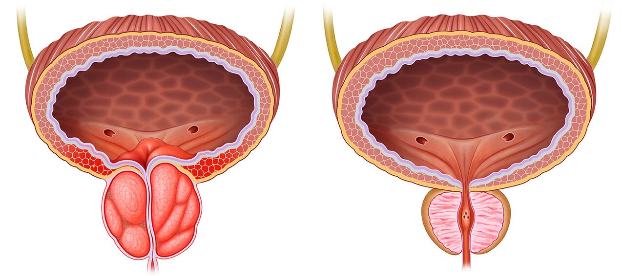 zapálená a zdravá prostata po užití kapsúl Predstonorm