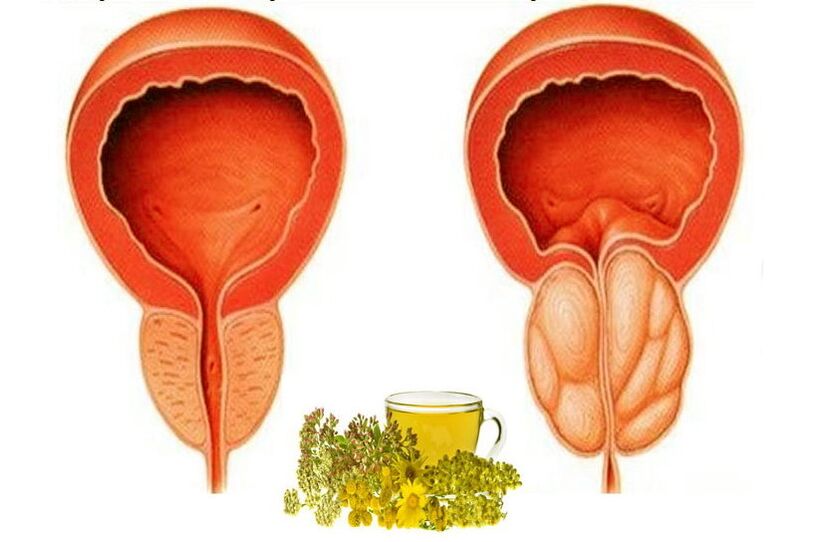 Zdravá a boľavá prostata